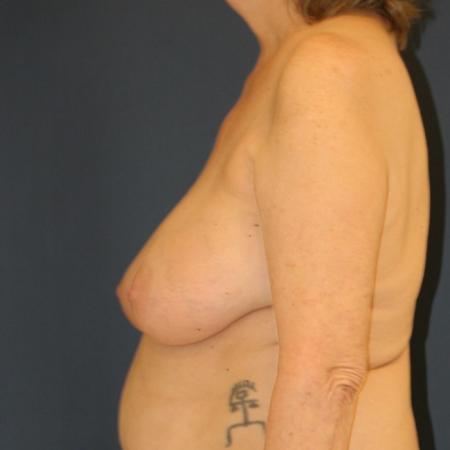 Before image 3 Case #109891 - Lollipop Breast Lift (Circumvertical Mastopexy)