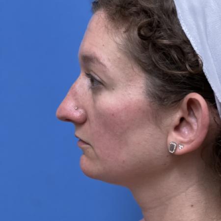Before image 3 Case #109801 - 36 year old  -  Open Septo-Rhinoplasty 