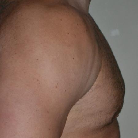 After image 3 Case #109991 - Gynecomastia and VASER liposuction of chest