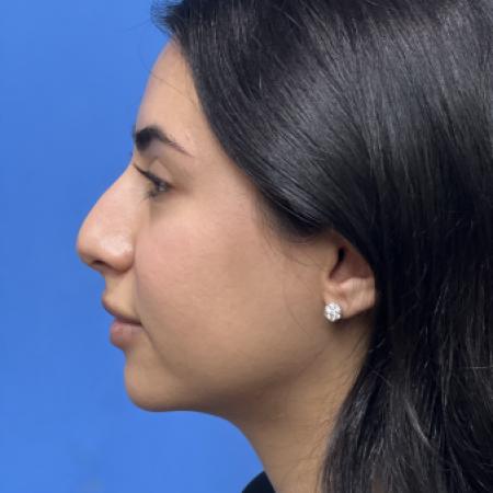 Before image 3 Case #109886 - 24 year old - Open Rhinoplasty- 6 months post-op