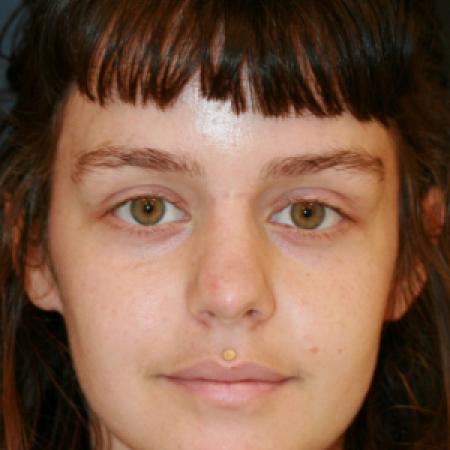 After image 1 Case #109901 - Female Rhinoplasty