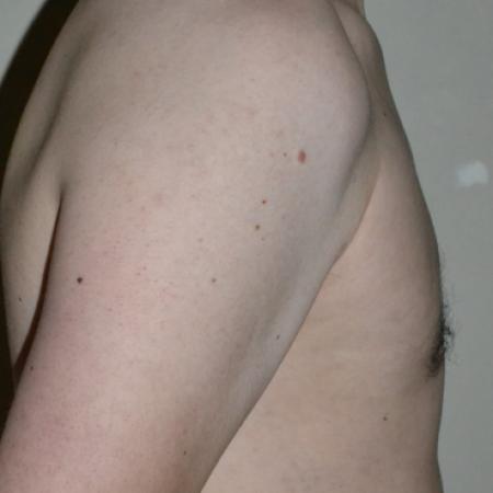 After image 3 Case #109976 - Gynecomastia  Surgery