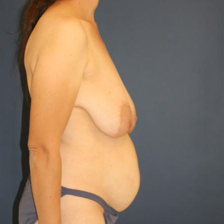Before image 3 Case #109896 - Mommy Makeover