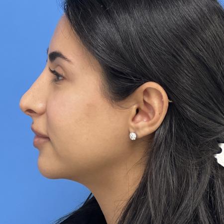 After image 3 Case #109886 - 24 year old - Open Rhinoplasty- 6 months post-op