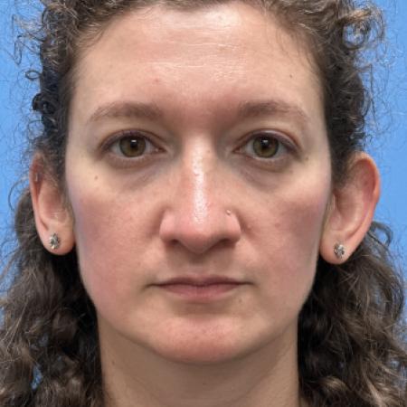 After image 1 Case #109801 - 36 year old  -  Open Septo-Rhinoplasty 
