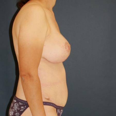 After image 3 Case #109896 - Mommy Makeover