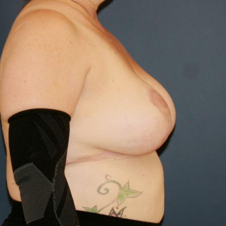 After image 3 Case #109906 - Lollipop Breast Lift + Implant Exchange