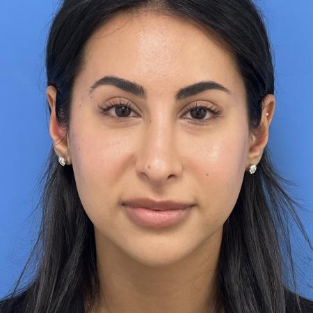 After image 1 Case #109886 - 24 year old - Open Rhinoplasty- 6 months post-op