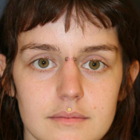 Before image 1 Case #109901 - Female Rhinoplasty