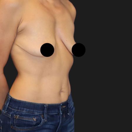 Before image 2 Case #109846 - 44 year-old breast augmentation and lift