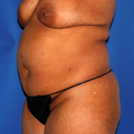 Before image 2 Case #110036 - Abdominoplasty and Liposuction of Flanks