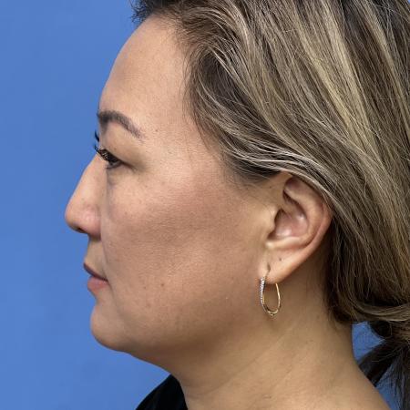 Before image 3 Case #110046 - 47 year old - Open Precision Rhinoplasty