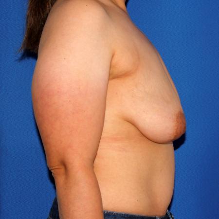 Before image 3 Case #110026 - Breast Lift with Implants
