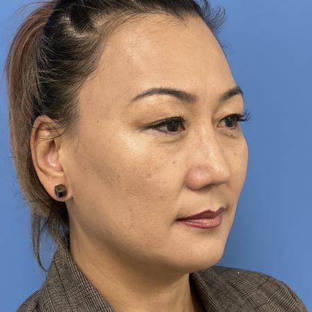 After image 2 Case #110046 - 47 year old - Open Precision Rhinoplasty