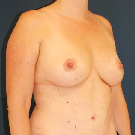 After image 2 Case #110071 - Donut Breast Lift