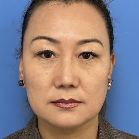 After image 1 Case #110046 - 47 year old - Open Precision Rhinoplasty