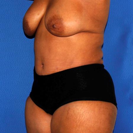 After image 2 Case #110036 - Abdominoplasty and Liposuction of Flanks