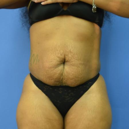 Before image 1 Case #110106 - Drainless tummy tuck with liposuction