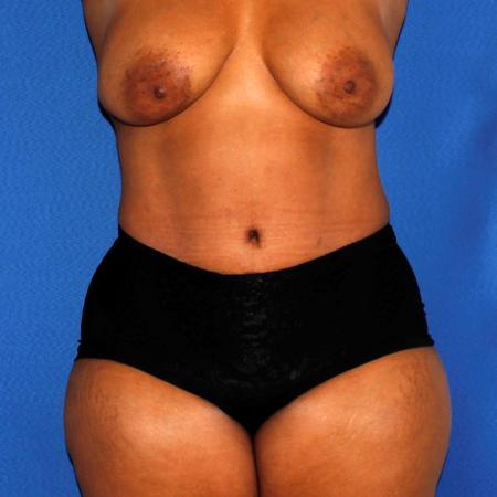After image 1 Case #110036 - Abdominoplasty and Liposuction of Flanks