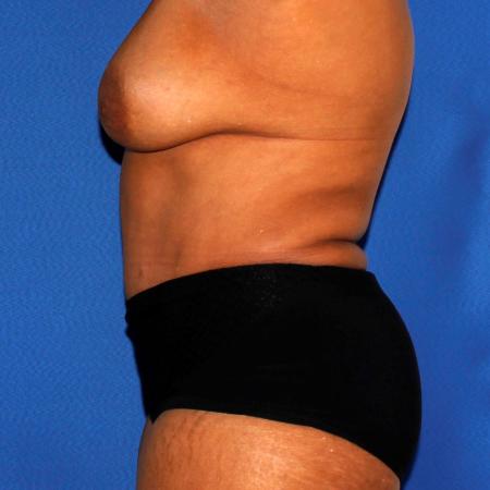 After image 3 Case #110036 - Abdominoplasty and Liposuction of Flanks