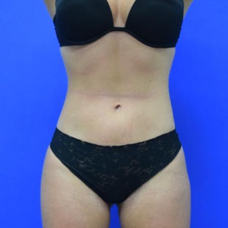 After image 1 Case #110116 - Skinny BBL