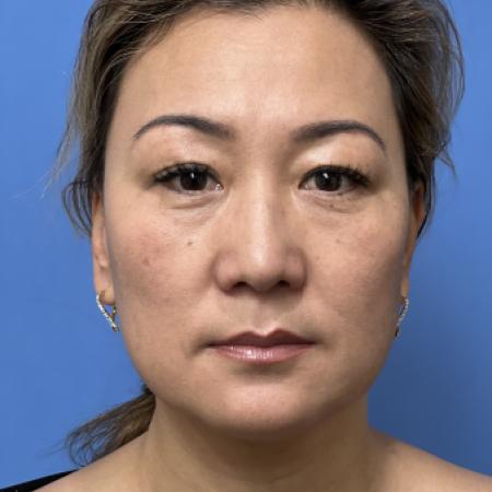 Before image 1 Case #110046 - 47 year old - Open Precision Rhinoplasty