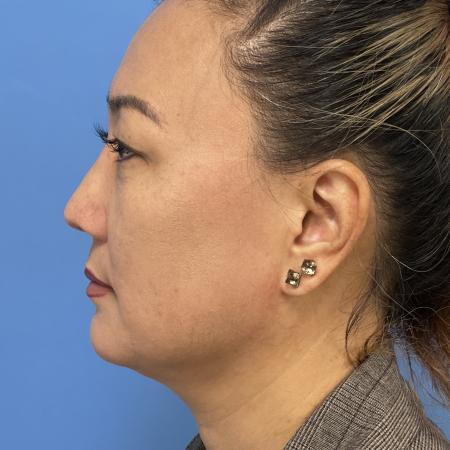 After image 3 Case #110046 - 47 year old - Open Precision Rhinoplasty