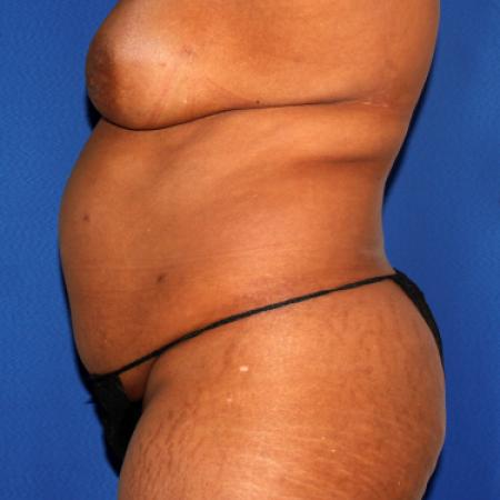 Before image 3 Case #110036 - Abdominoplasty and Liposuction of Flanks