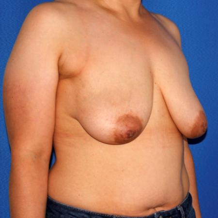 Before image 2 Case #110026 - Breast Lift with Implants