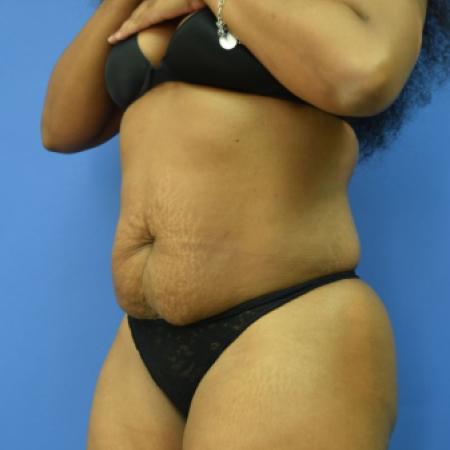 Before image 2 Case #110106 - Drainless tummy tuck with liposuction