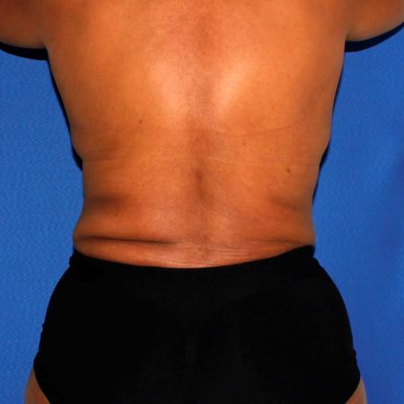 After image 4 Case #110036 - Abdominoplasty and Liposuction of Flanks