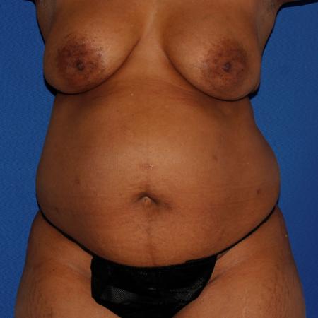 Before image 1 Case #110036 - Abdominoplasty and Liposuction of Flanks