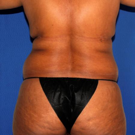 Before image 4 Case #110036 - Abdominoplasty and Liposuction of Flanks