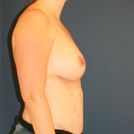 After image 3 Case #110071 - Donut Breast Lift