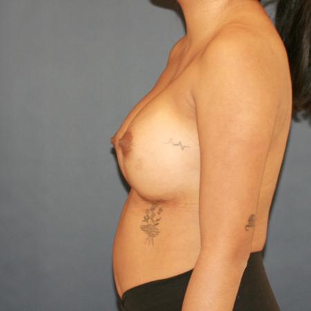 After image 3 Case #110176 - Breast Augmentation