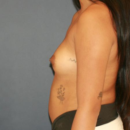 Before image 3 Case #110176 - Breast Augmentation