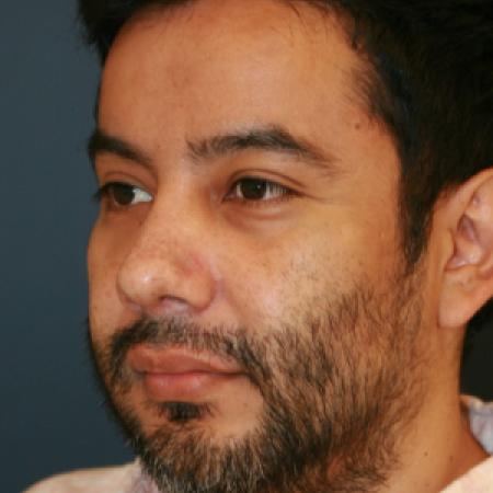 After image 1 Case #110236 - Male Open Rhinoplasty