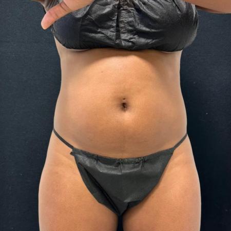 Before image 1 Case #110156 - CoolSculpting Elite (Two Sessions)