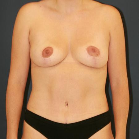 After image 1 Case #110171 - Mommy Makeover