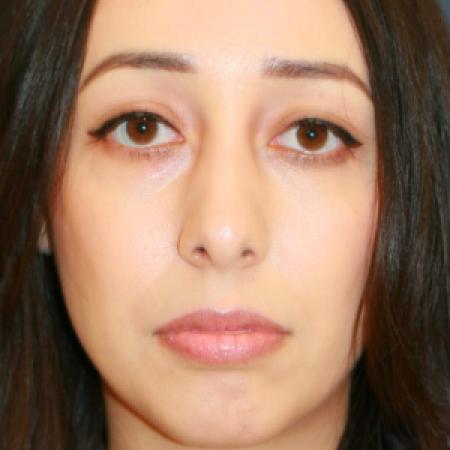 After image 1 Case #110166 - Female Rhinoplasty