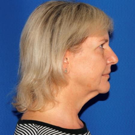 Before image 3 Case #110231 - Deep Plane Facelift and Necklift