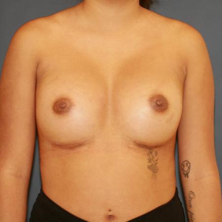 After image 1 Case #110176 - Breast Augmentation