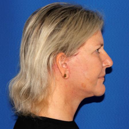 After image 3 Case #110231 - Deep Plane Facelift and Necklift