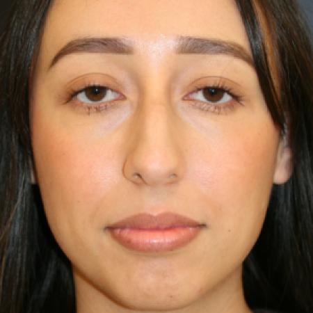 Before image 1 Case #110166 - Female Rhinoplasty