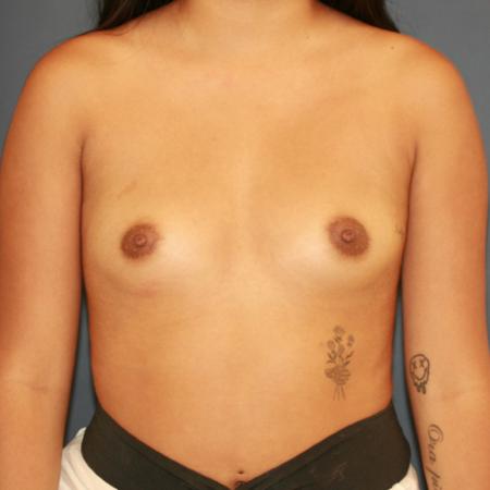 Before image 1 Case #110176 - Breast Augmentation