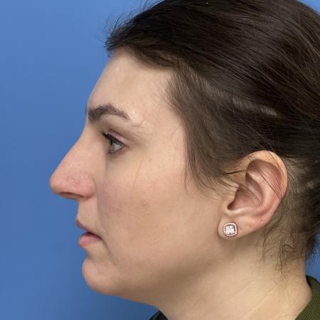 After image 3 Case #110286 - 31 year old-Open Septo Rhinoplasty