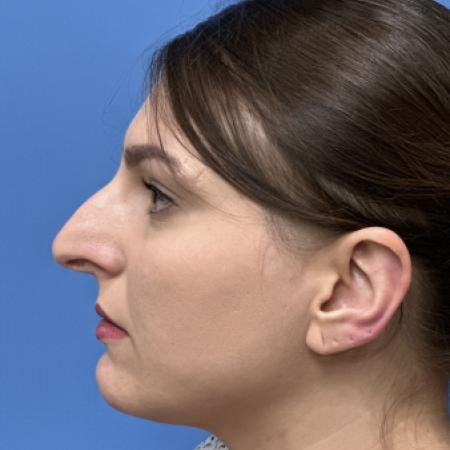 Before image 3 Case #110286 - 31 year old-Open Septo Rhinoplasty