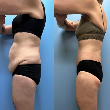 Before image 3 Case #111336 - Body Lift