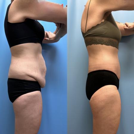 After image 3 Case #111336 - Body Lift