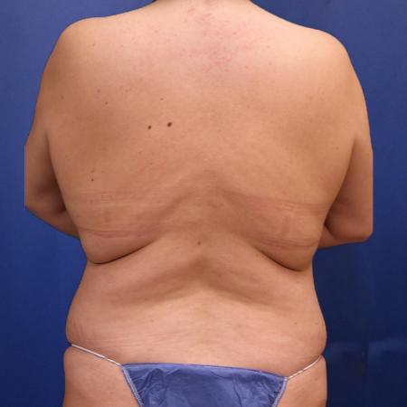 Before image 4 Case #111326 - Abdominoplasty and 360 lipo